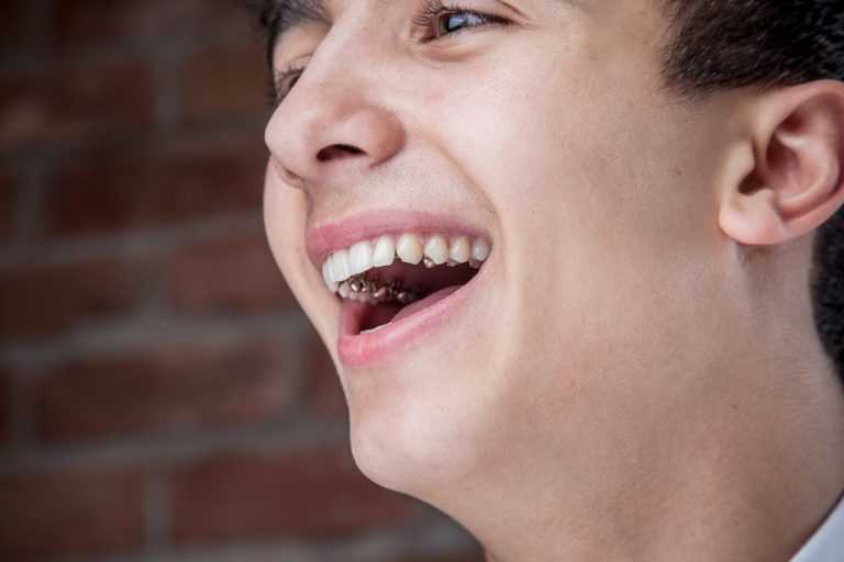 Lingual ortodonti tedavisi hakkında bilgiler