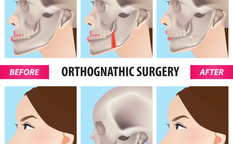  Ortognatik Cerrahi