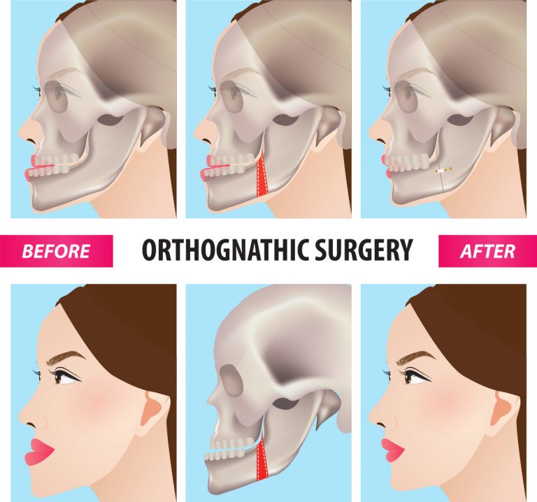 ortognatik cerrahi nedir ?